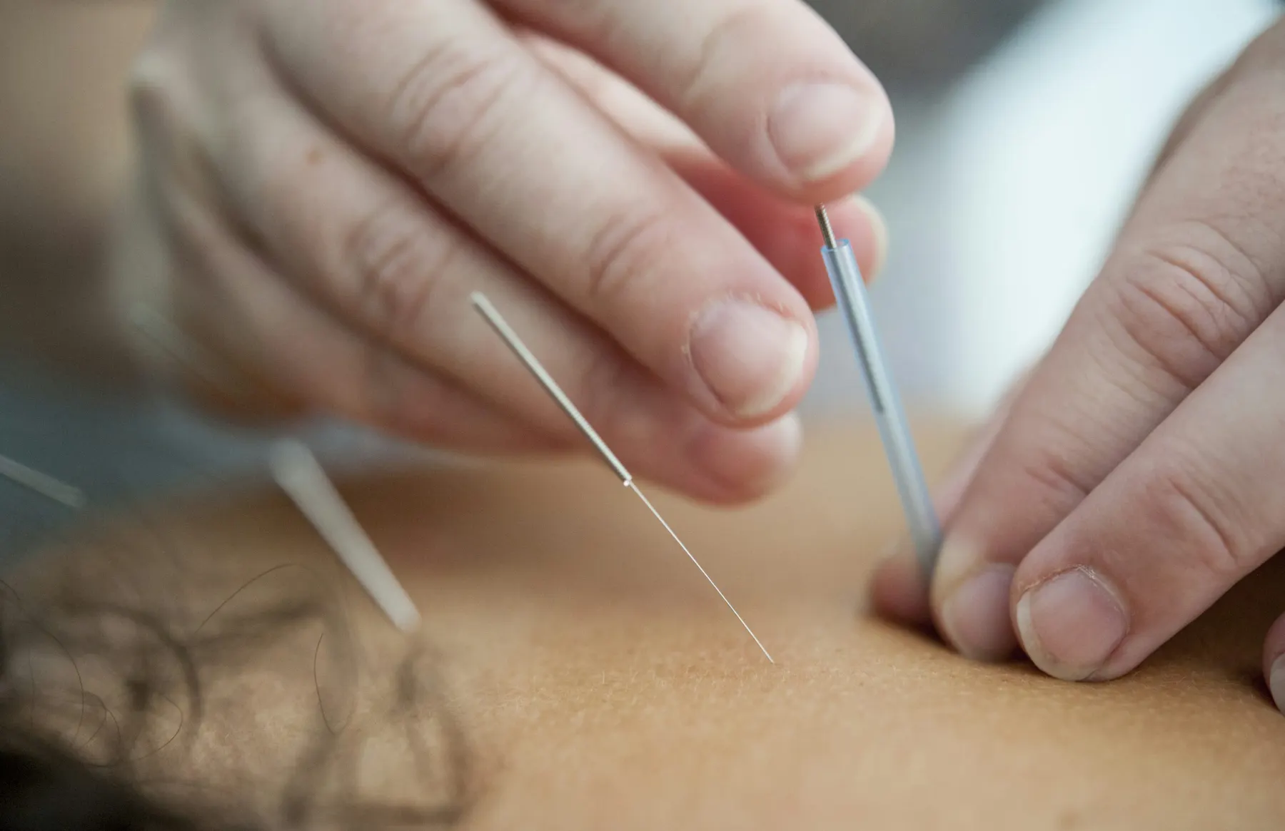 Close-up of acupuncture needles being placed during treatment